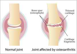 What are rooster injections for arthritic knees?